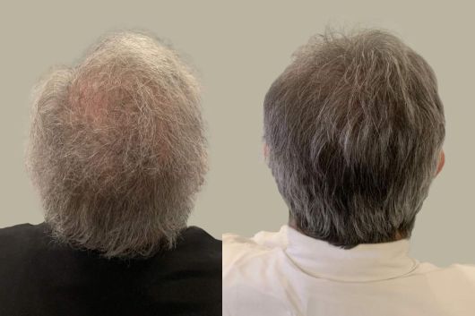 peluquería centro valencia foto antes y despues tratamiento caída de cabello