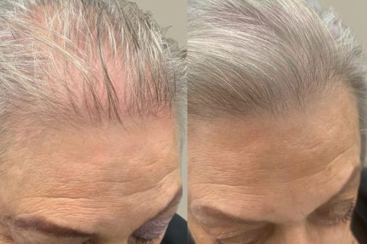 peluquería mujer valencia foto antes y despues tratamiento caída de cabello